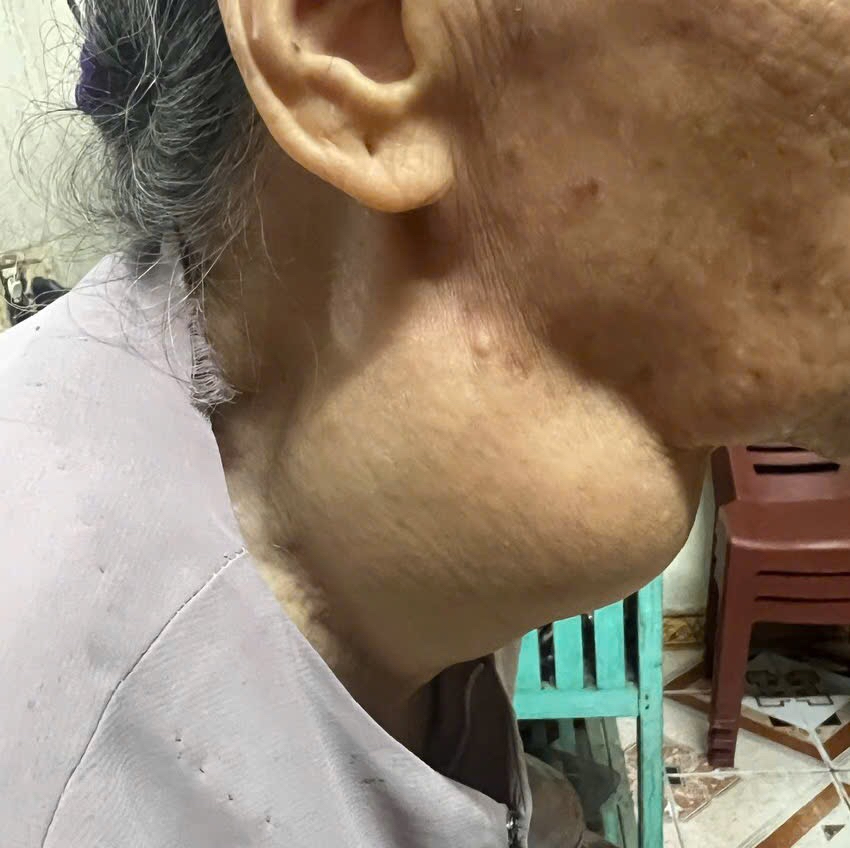 Khối u tuyến gi&aacute;p khổng lồ g&acirc;y kh&oacute; khăn trong h&iacute;t thở v&agrave; sinh hoạt h&agrave;ng ng&agrave;y cho bệnh nh&acirc;n.