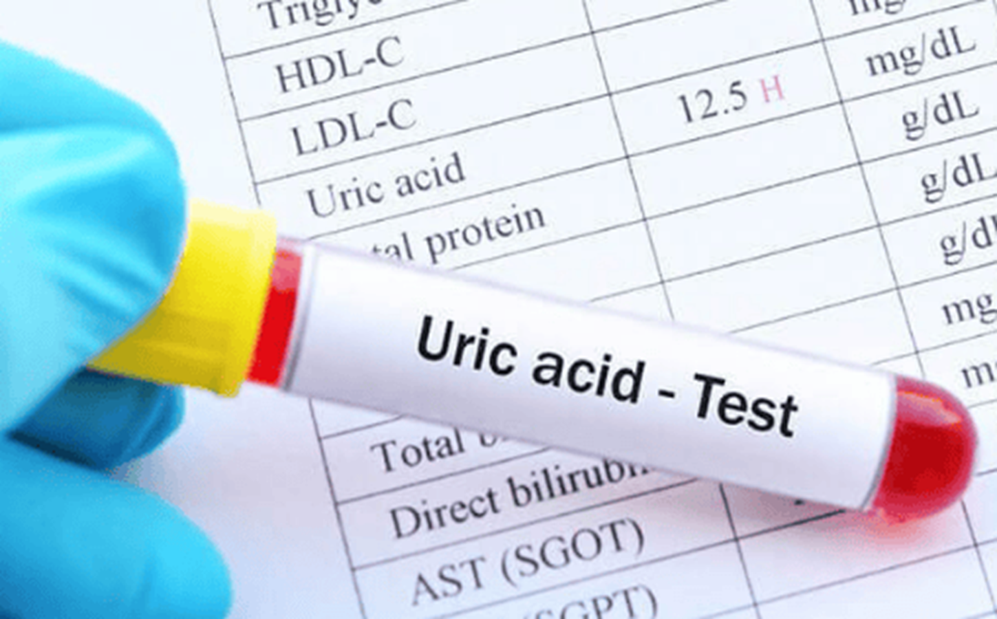 Lý giải hiện tượng chỉ số axit uric máu không giảm dù đã thực hiện chế độ ăn kiêng nghiêm ngặt