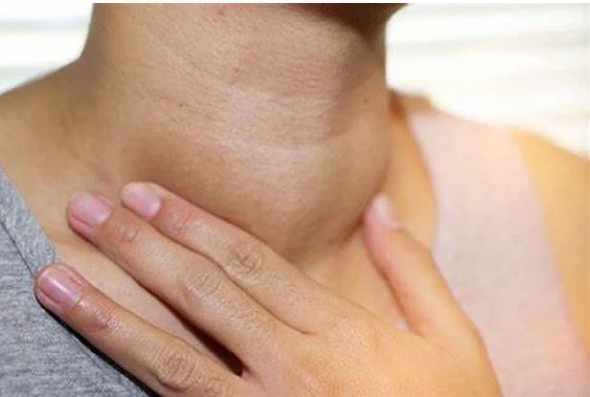 Bướu cổ lành tính cần được theo dõi định kỳ để đánh giá nguy cơ tiến triển Bướu cổ lành tính cần được theo dõi định kỳ để đánh giá nguy cơ tiến triển