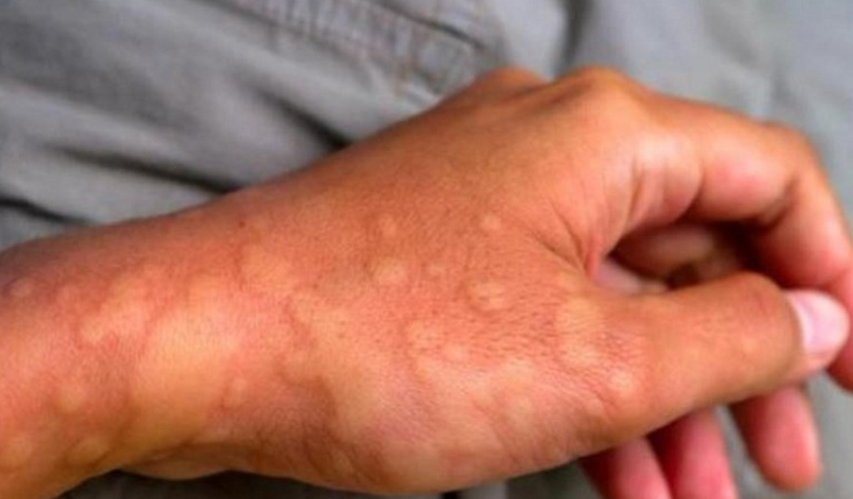 Mề đay, dị ứng bùng phát nhiều lần khiến người bệnh mệt mỏi, khó chịu Mề đay, dị ứng bùng phát nhiều lần khiến người bệnh mệt mỏi, khó chịu