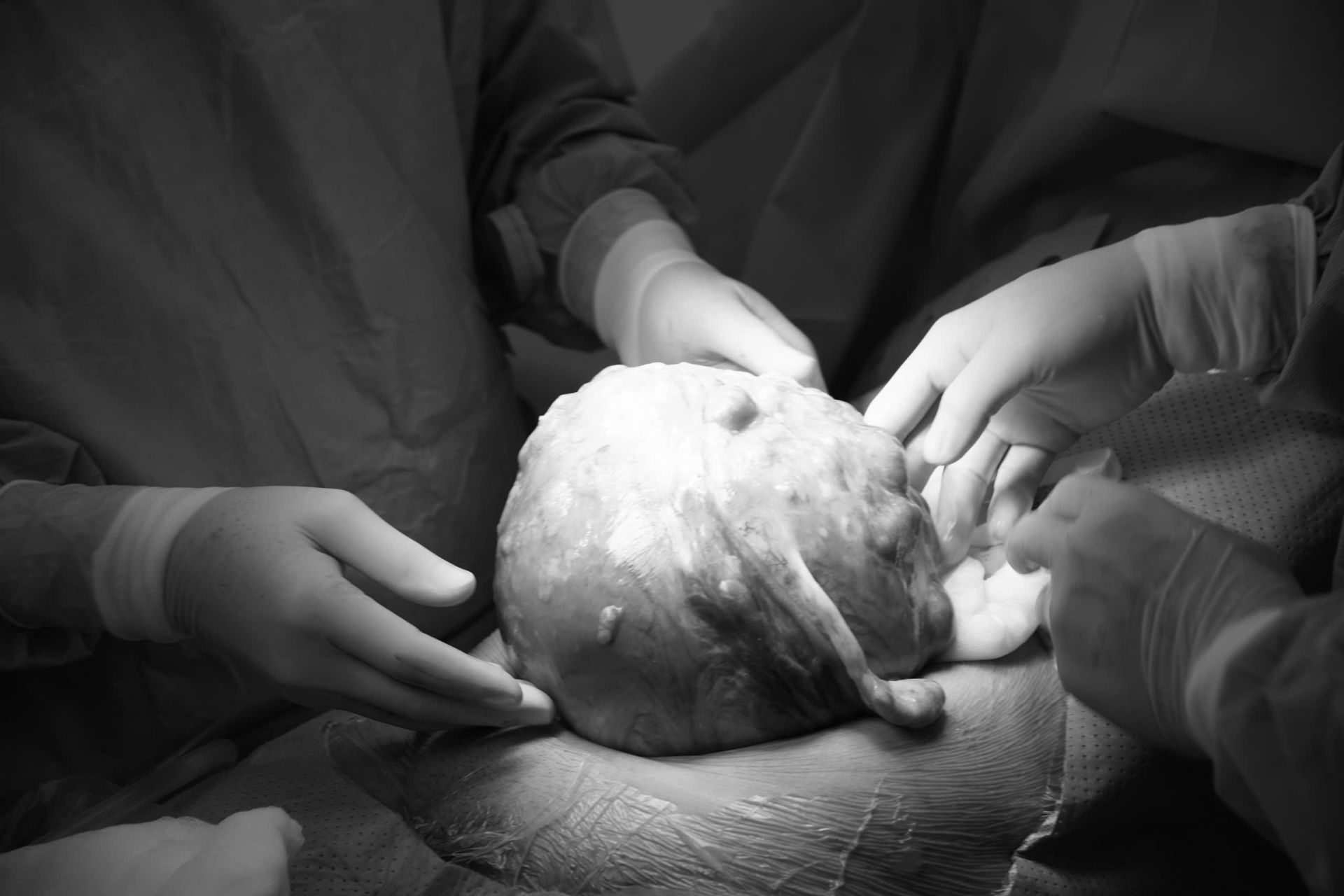 Khối nhân xơ nặng gần 3,4 kg Khối nhân xơ nặng gần 3,4 kg