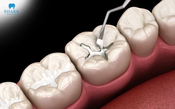 Gi&aacute; tr&aacute;m răng hiện nay thường c&oacute; mức dao động kh&aacute;c linh hoạt trong khoảng từ 250.000 - 700.000 VNĐ/răng