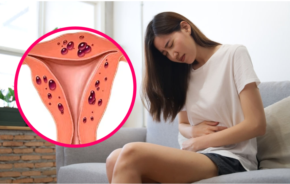 U nang buồng trứng c&oacute; thế khiến cho kinh nguyệt bị rối loạn thất thường
