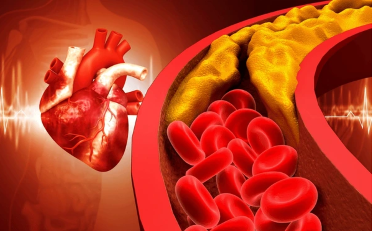 Tăng huyết áp là thủ phạm gây xơ vữa động mạch Tăng huyết áp là thủ phạm gây xơ vữa động mạch