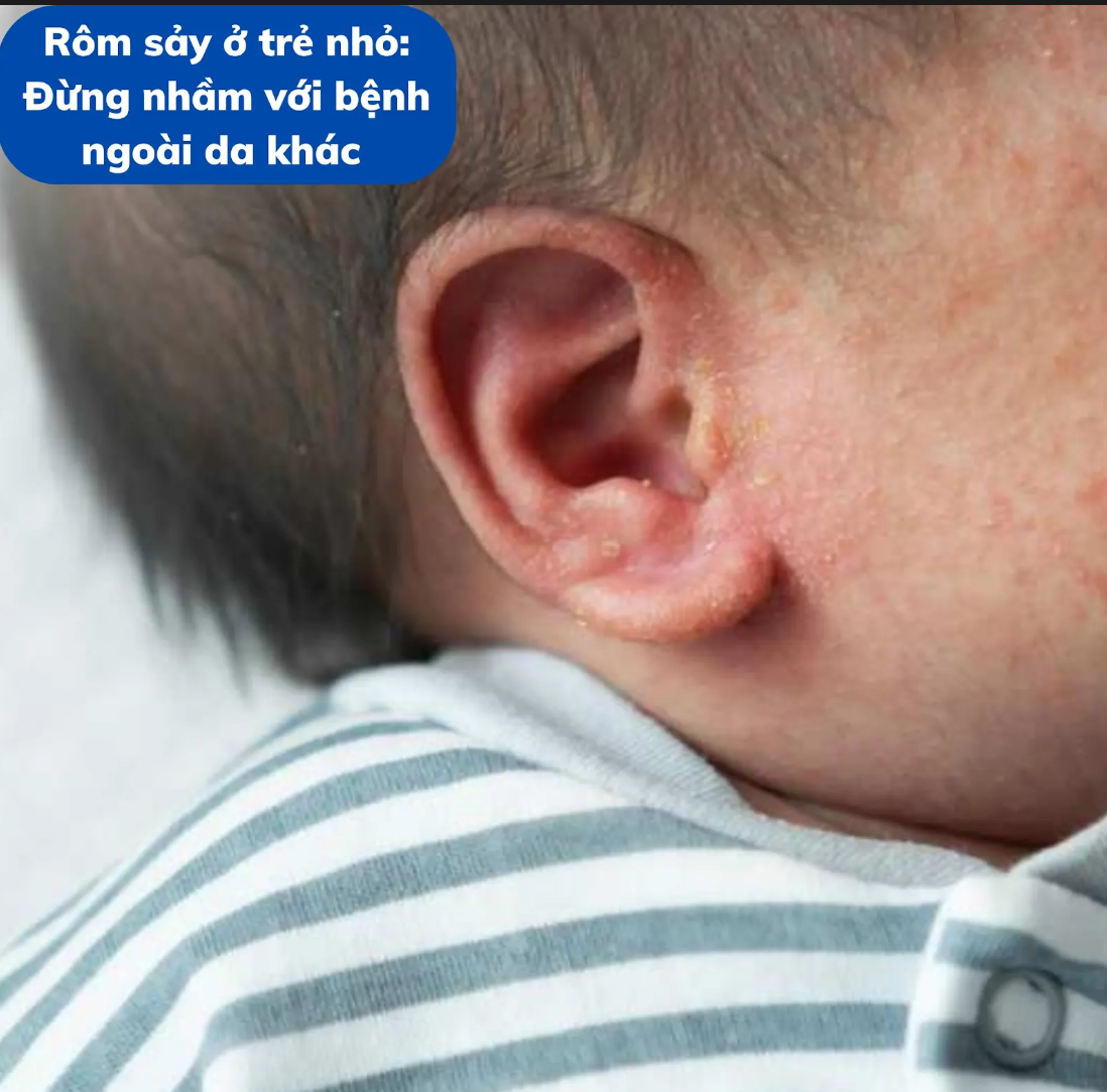 Rôm sảy ở trẻ nhỏ: Đừng nhầm với bệnh ngoài da khác