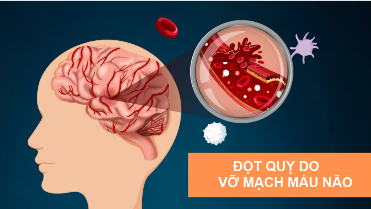 Huyết áp không ổn định có thể gây vỡ mạch máu não Huyết áp không ổn định có thể gây vỡ mạch máu não