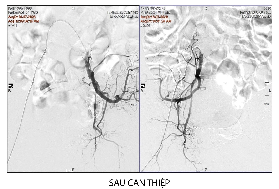 Hình ảnh sau can thiệp Hình ảnh sau can thiệp