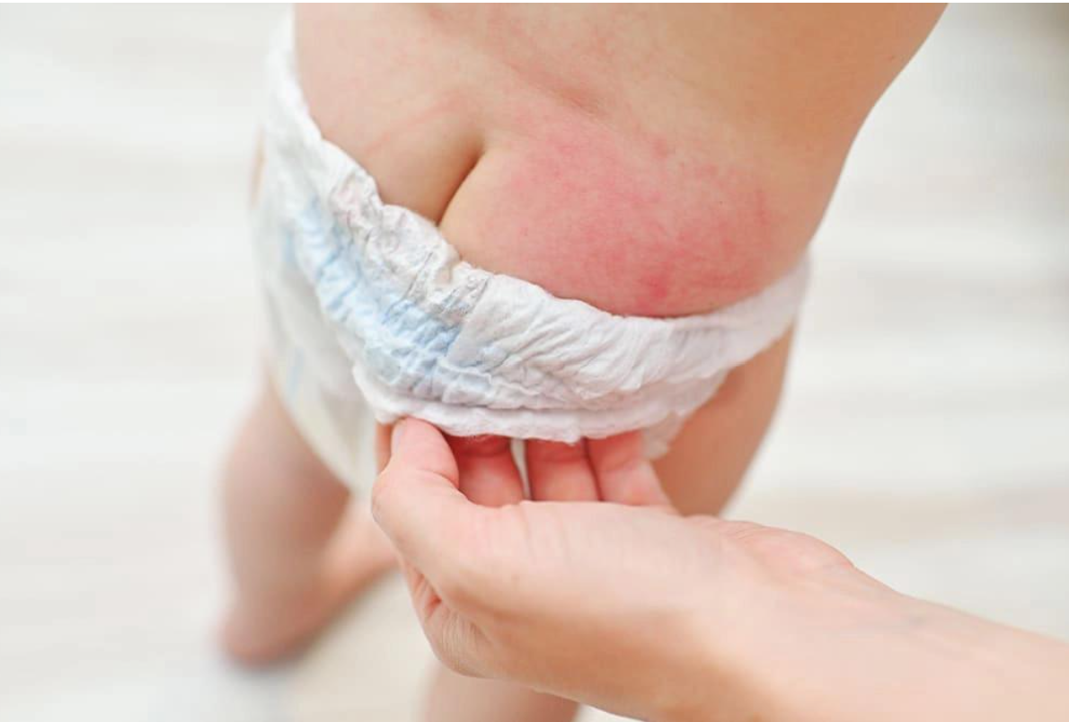 Lớp biểu b&igrave; ở da trẻ mỏng manh n&ecirc;n b&eacute; rất dễ bị hăm t&atilde;