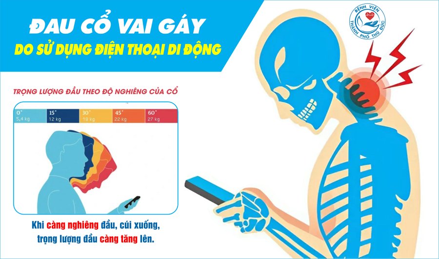 Việc thường xuyên cúi đầu, khom lưng hoặc giữ một tư thế trong thời gian dài để nhìn điện thoại có thể gây đau cổ, vai, lưng, tay và mỏi mắt. Việc thường xuyên cúi đầu, khom lưng hoặc giữ một tư thế trong thời gian dài để nhìn điện thoại có thể gây đau cổ, vai, lưng, tay và mỏi mắt.
