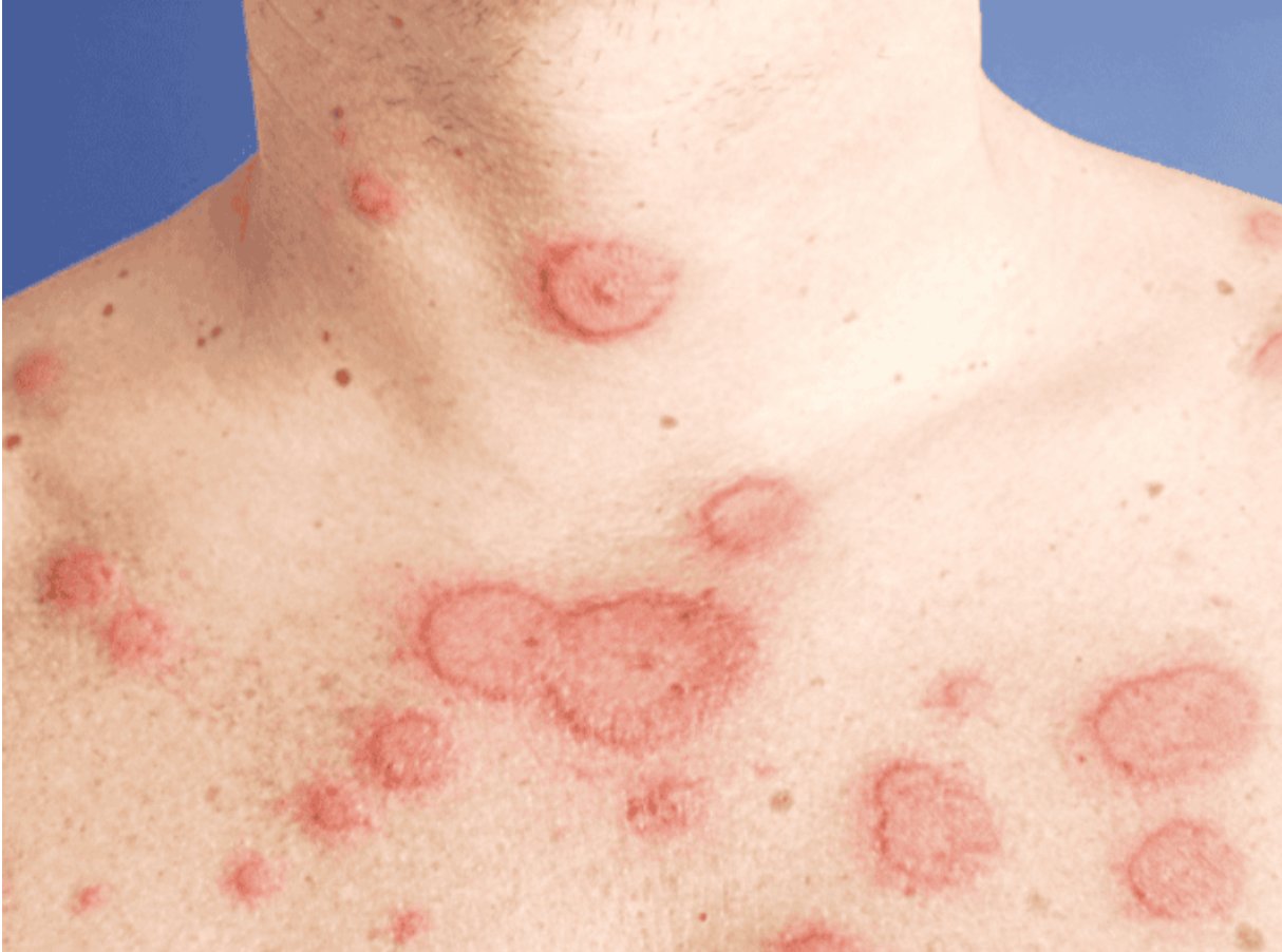 Lupus ban đỏ dạng đĩa thường xuất hiện với c&aacute;c mảng đỏ, bong vảy