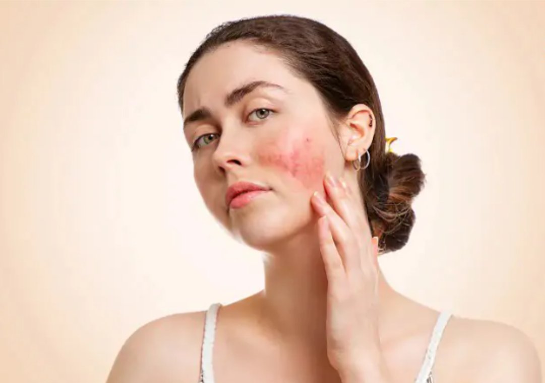Tr&aacute;nh nắng gi&uacute;p giảm nguy cơ b&ugrave;ng ph&aacute;t lupus ban đỏ dạng đĩa v&agrave; hạn chế sẹo