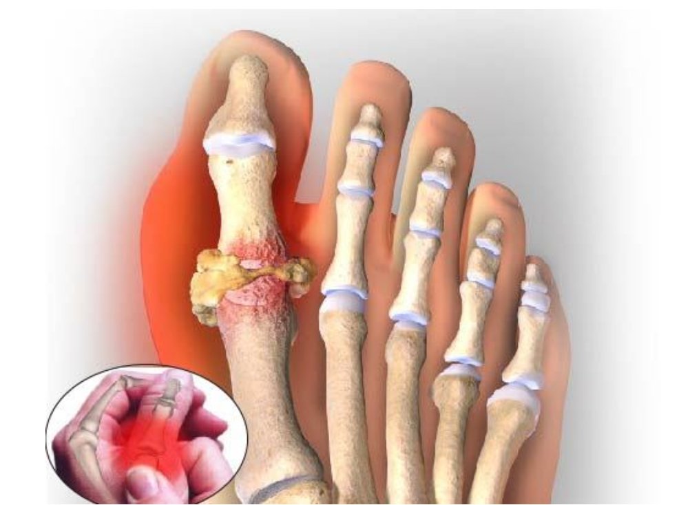 Gút tái phát nhiều lần khiến khớp bị tổn thương nặng nề Gút tái phát nhiều lần khiến khớp bị tổn thương nặng nề
