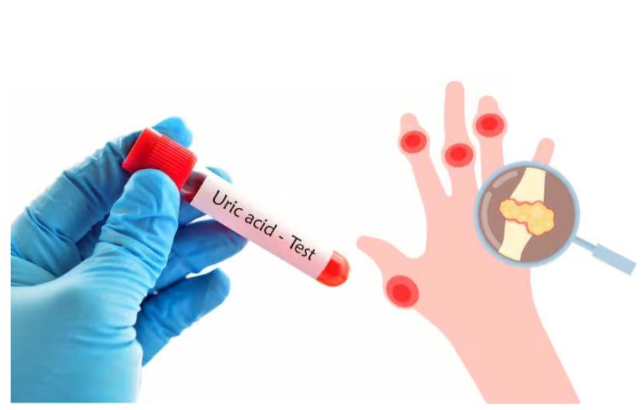 Kiểm soát acid uric sẽ giúp bảo vệ khớp ở người bệnh gút Kiểm soát acid uric sẽ giúp bảo vệ khớp ở người bệnh gút