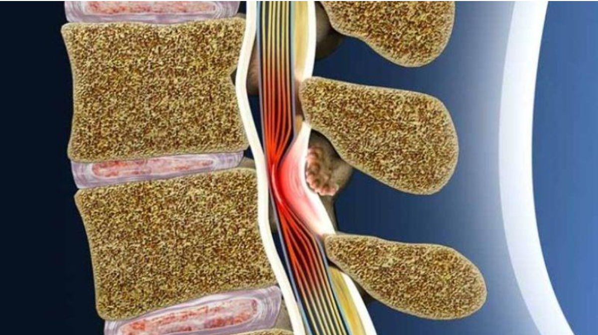 Hẹp ống sống l&agrave; biến chứng nguy hiểm của tho&aacute;i h&oacute;a cột sống