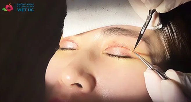 Nh&acirc;n vi&ecirc;n y tế cắt chỉ vết thương tại nh&agrave; của ph&ograve;ng kh&aacute;m gia đ&igrave;nh Việt &Uacute;c.