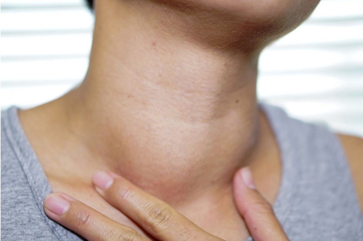 Bướu tuyến giáp đang được phát hiện ngày càng nhiều ở người trẻ Bướu tuyến giáp đang được phát hiện ngày càng nhiều ở người trẻ