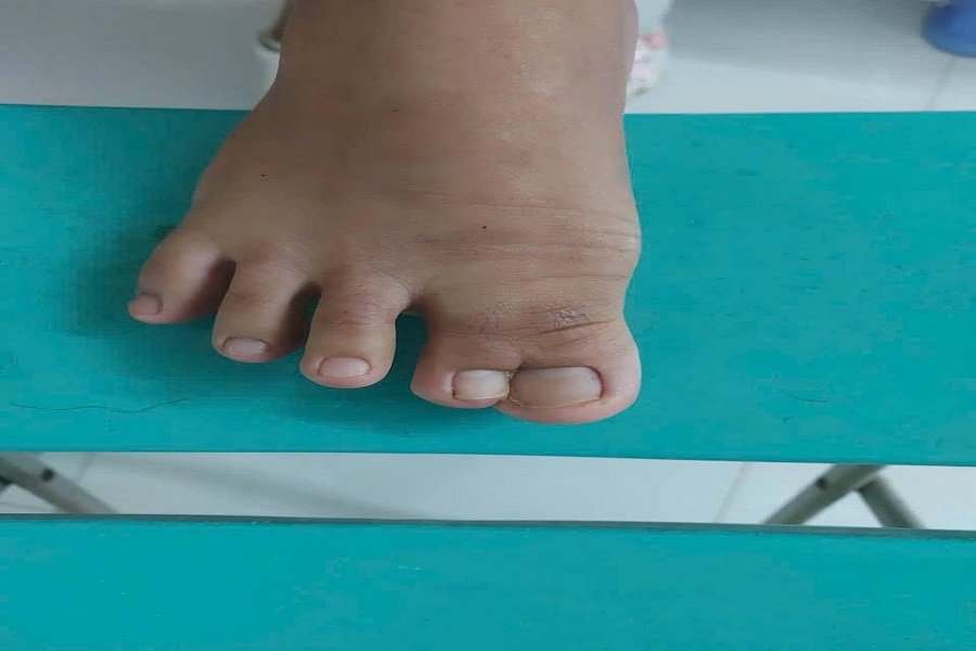 Trước phẫu thuật, bàn chân phải của bệnh nhi dính hoàn toàn ngón chân cái (ngón I) và ngón thứ II dạng màng. (Ảnh: Bệnh viện II Lâm Đồng) Trước phẫu thuật, bàn chân phải của bệnh nhi dính hoàn toàn ngón chân cái (ngón I) và ngón thứ II dạng màng. (Ảnh: Bệnh viện II Lâm Đồng)