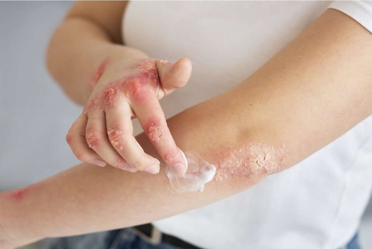 Thuốc b&ocirc;i gi&uacute;p kiểm so&aacute;t nhanh tổn thương vảy nến nhưng cần sử dụng đ&uacute;ng loại v&agrave; đ&uacute;ng thời gian
