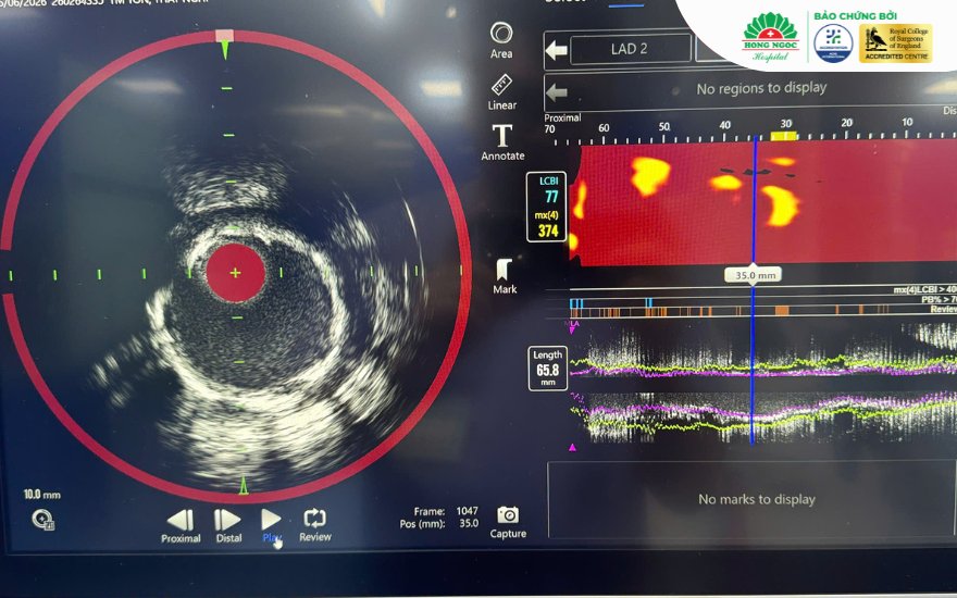 Kết quả chụp Ivus - Nirs của người bệnh