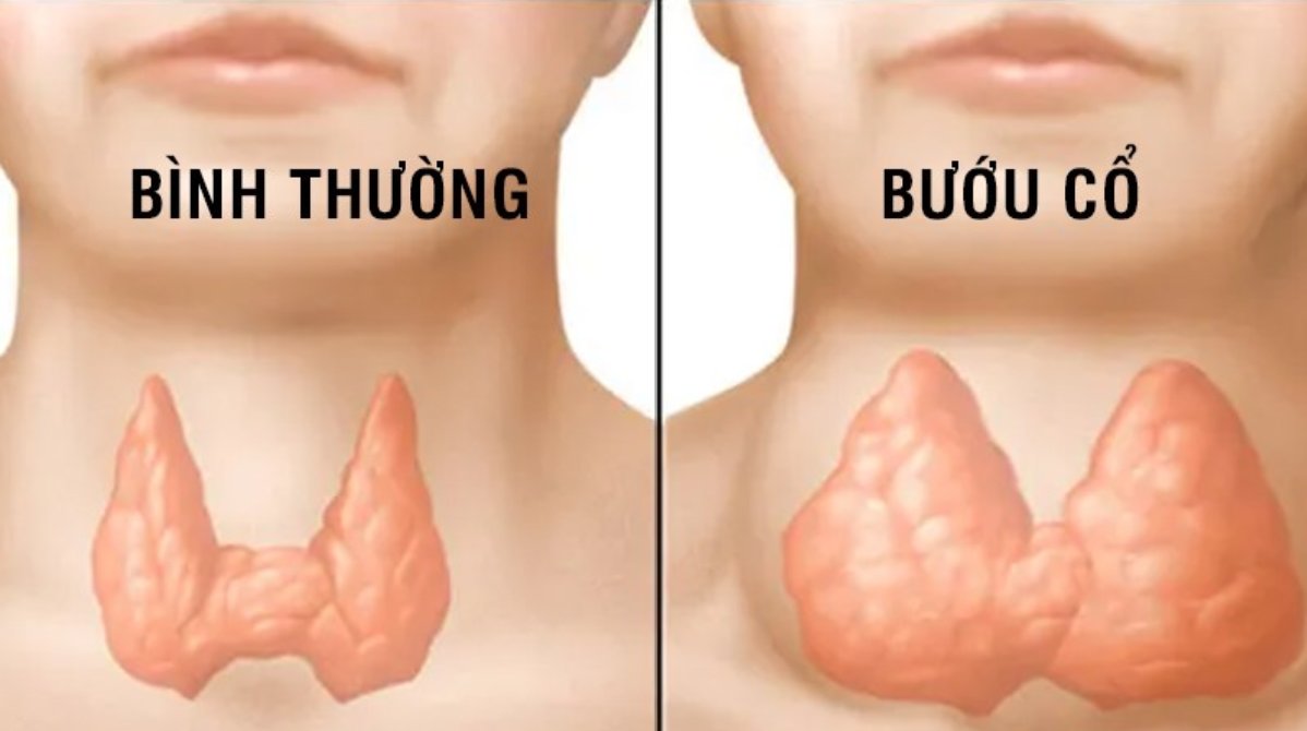 Cẩn trọng khi ph&aacute;t hiện bướu cổ l&agrave;nh t&iacute;nh