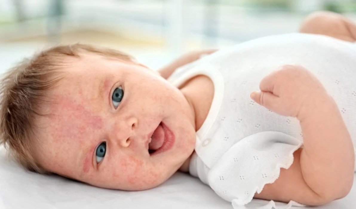 Cha mẹ n&ecirc;n ưu ti&ecirc;n quần &aacute;o mềm, tho&aacute;ng khi trẻ bị r&ocirc;m sảy