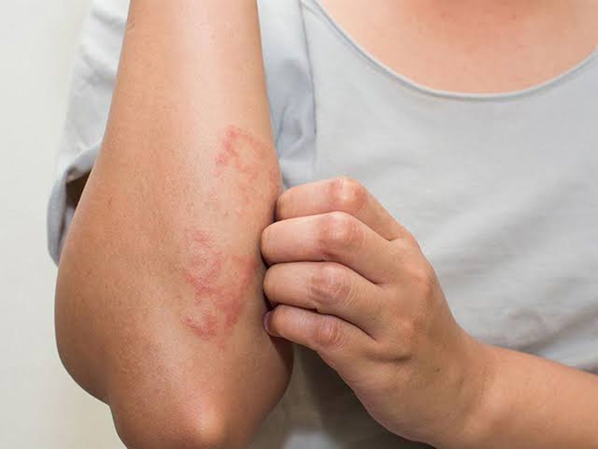 Ngứa thường do kh&ocirc; da, dị ứng hoặc bệnh da liễu