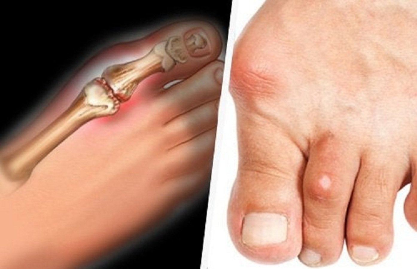 Để chủ động phòng ngừa và kiểm soát chỉ số axit uric, người dân nên duy trì thói quen uống đủ nước hằng ngày, hạn chế các loại đồ uống chứa nhiều đường fructose, giảm tiêu thụ rượu bia và kiểm soát cân nặng hợp lý Để chủ động phòng ngừa và kiểm soát chỉ số axit uric, người dân nên duy trì thói quen uống đủ nước hằng ngày, hạn chế các loại đồ uống chứa nhiều đường fructose, giảm tiêu thụ rượu bia và kiểm soát cân nặng hợp lý