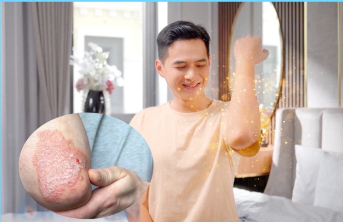 Dưỡng ẩm là bước quan trọng trong quá trình chăm sóc da ở người vảy nến Dưỡng ẩm là bước quan trọng trong quá trình chăm sóc da ở người vảy nến