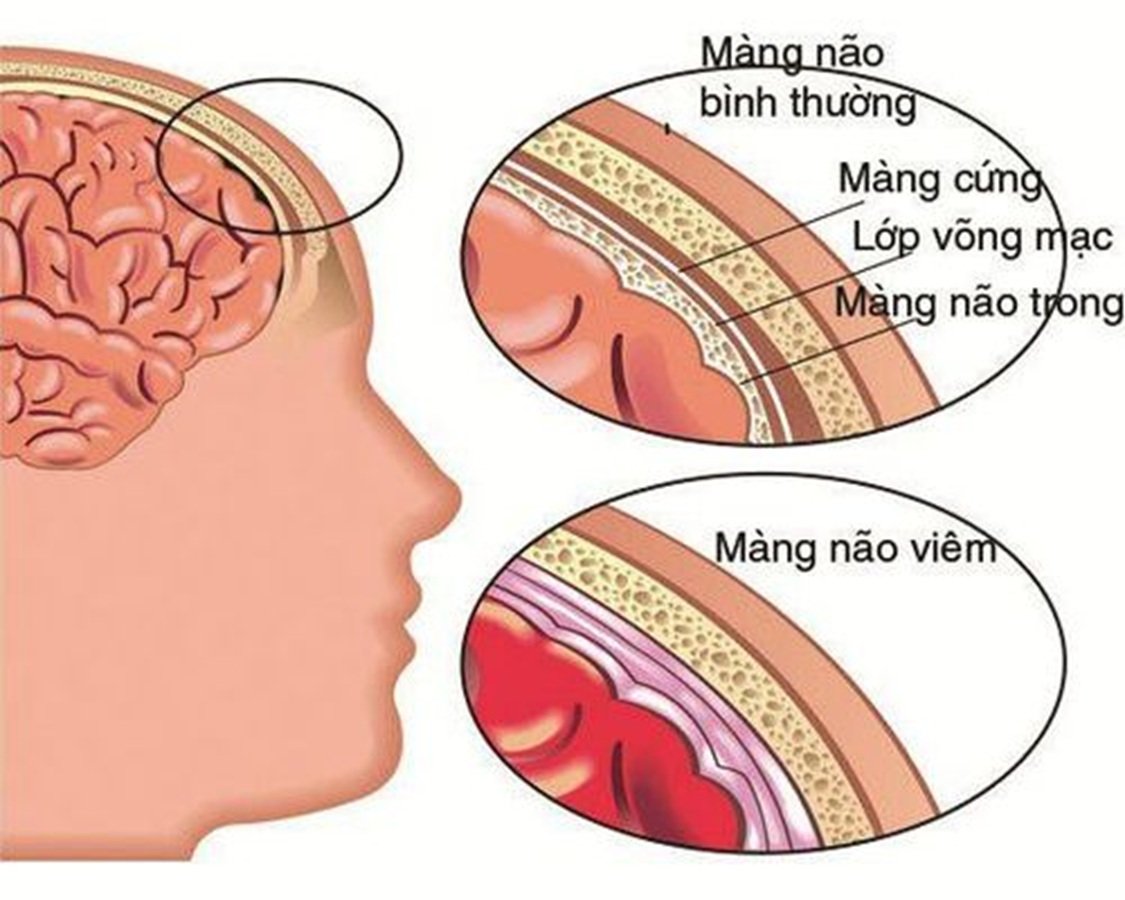 Bệnh não mô cầu nằm ở các dấu hiệu khởi phát rất giống cảm cúm thông thường, bao gồm sốt cao đột ngột, đau đầu dữ dội, mệt mỏi và cảm giác buồn nôn Bệnh não mô cầu nằm ở các dấu hiệu khởi phát rất giống cảm cúm thông thường, bao gồm sốt cao đột ngột, đau đầu dữ dội, mệt mỏi và cảm giác buồn nôn