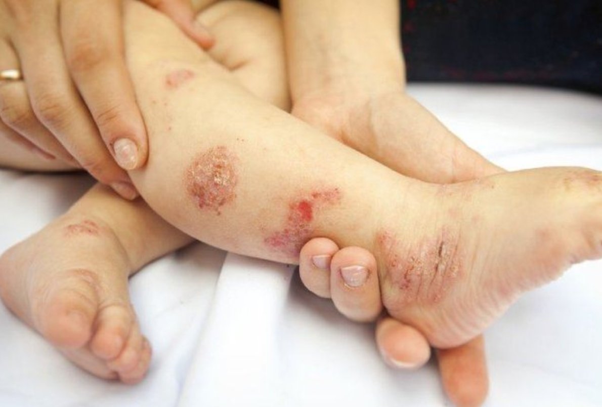Viêm da là tình trạng thường gặp ở trẻ nhỏ Viêm da là tình trạng thường gặp ở trẻ nhỏ