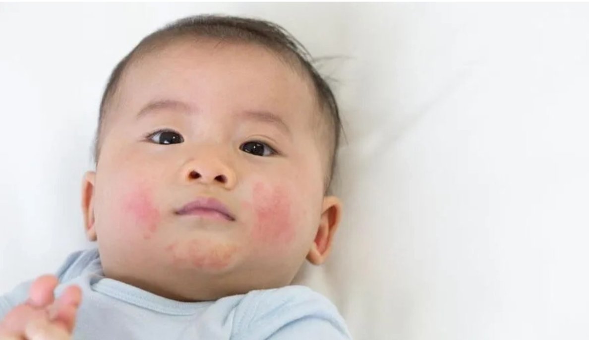 Mặc quần áo quá dày và bí khiến có thể làm khởi phát viêm da ở trẻ Mặc quần áo quá dày và bí khiến có thể làm khởi phát viêm da ở trẻ
