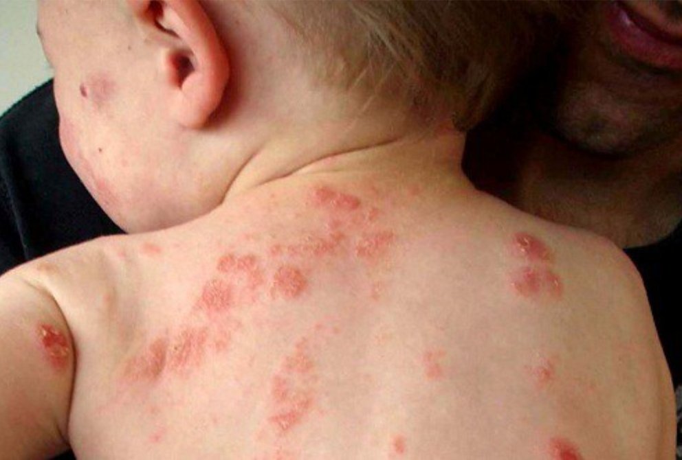 Viêm da khiến da bé ngứa ngáy khó chịu Viêm da khiến da bé ngứa ngáy khó chịu