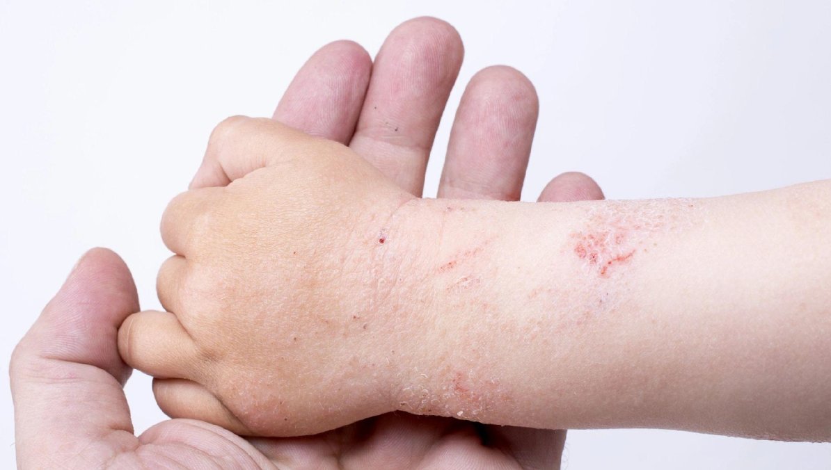 Chăm sóc viêm da cần hướng đến việc duy trì độ ẩm tự nhiên cho da Chăm sóc viêm da cần hướng đến việc duy trì độ ẩm tự nhiên cho da