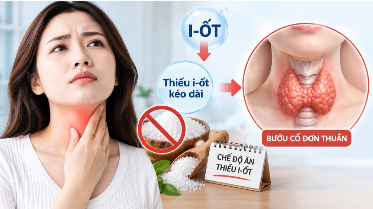 Nguyên nhân gây bướu cổ đơn thuần phổ biến nhất là thiếu i-ốt kéo dài Nguyên nhân gây bướu cổ đơn thuần phổ biến nhất là thiếu i-ốt kéo dài