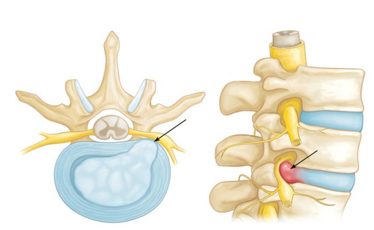 Thoát vị đĩa đệm là biến chứng thường gặp khi bị thoái hóa cột sống lâu năm Thoát vị đĩa đệm là biến chứng thường gặp khi bị thoái hóa cột sống lâu năm